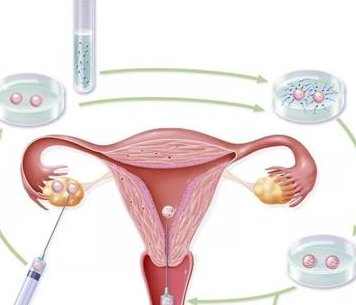 女性子宫肌瘤在川北医学院附属医院做三代试管预算八万块够不够？